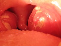 Tonsillitis Tonsillitis