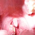 Tonsillitis