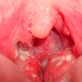 Tonsil Stones