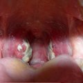 Get Rid of Tonsil Stones