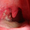 Bad breath causes, halitosis causes, cure