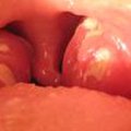 Pus on tonsils  
