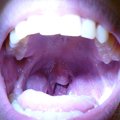 Halitosis causes