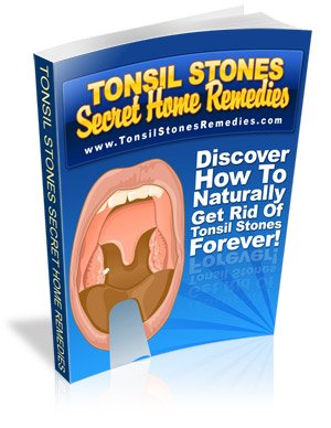 Get Rid of Tonsil Stones