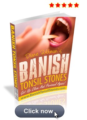 Banish Tonsil Stones Banish Tonsil Stones
