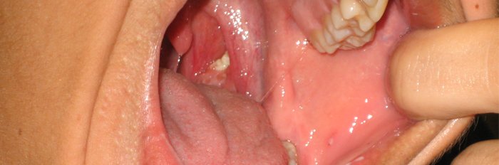 Dealing With Tonsillitis Effectively, Naturally, And Completely