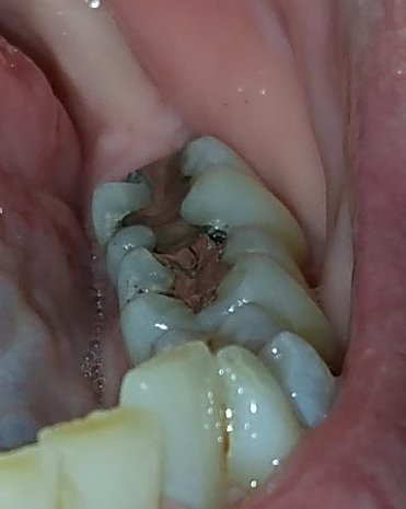 clean molars to prevent tonsil stones