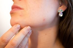 whrn to choose home remedies to cure tonsil stones