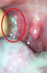 Pus on tonsils, How to Treat Pus on Tonsils, Home Remedies, get rid of, green Pus on tonsils, control