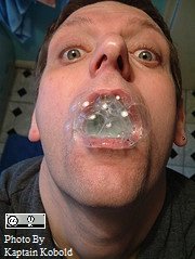 gargling mouthwash tonsil stones, gargling mouthwash tonsillitis, does gargling mouthwash help tonsillitis, does gargling mouthwash help tonsil stones