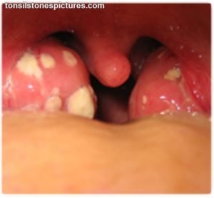 Are tonsil stones harmful