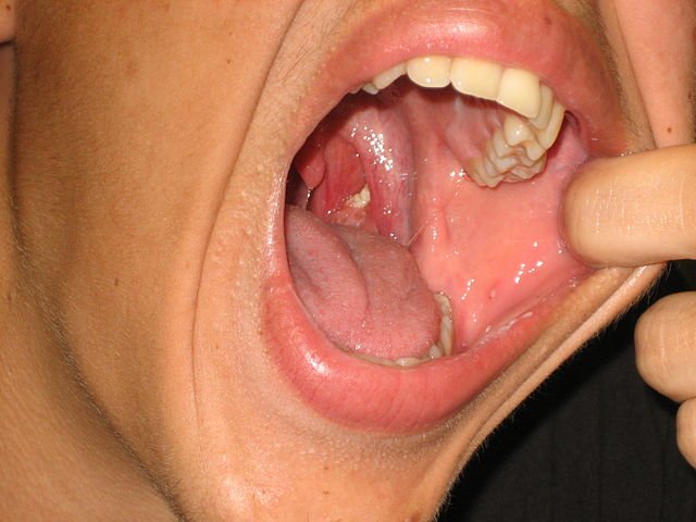 difference between normal and dark colored tonsil stones